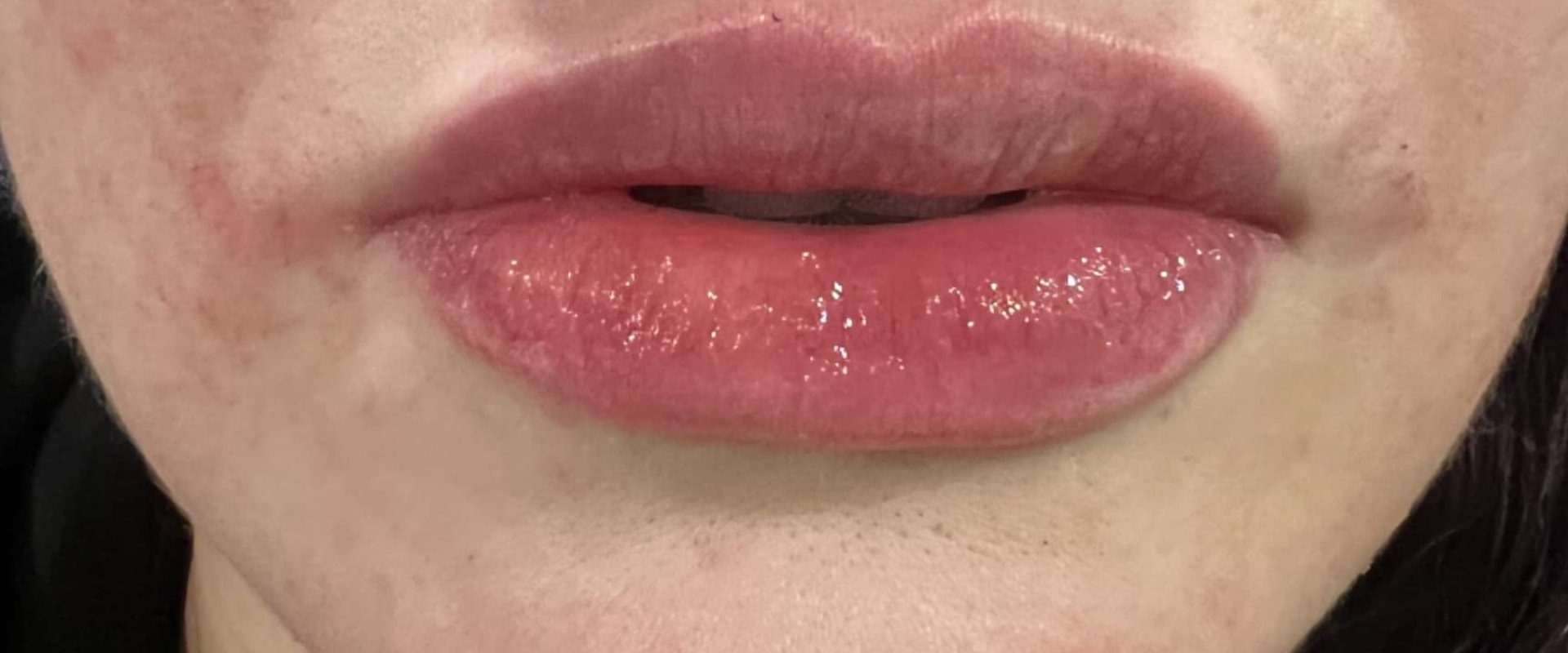 Premium Lip fillers from Medical Weight Loss and Beauty