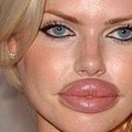 Are Lip Fillers Plastic Surgery? A Comprehensive Guide