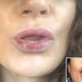 The Dangers of Lip Fillers: What You Need to Know