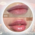 Skin Tightening, Botox and Lip Fillers by Skinsation LA offers Lip fillers