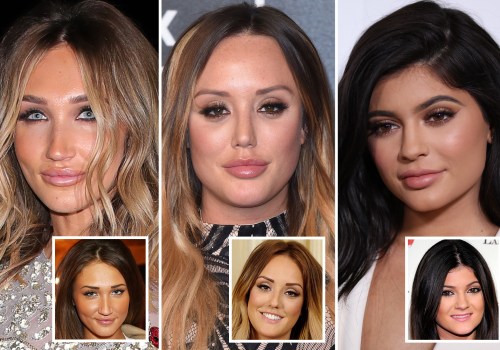 Celebrities Who Use Lip Fillers: A Comprehensive Guide