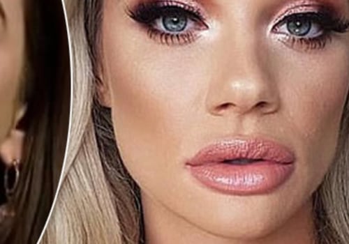 Why Lip Fillers Look Bad: A Guide to Achieving Natural Results