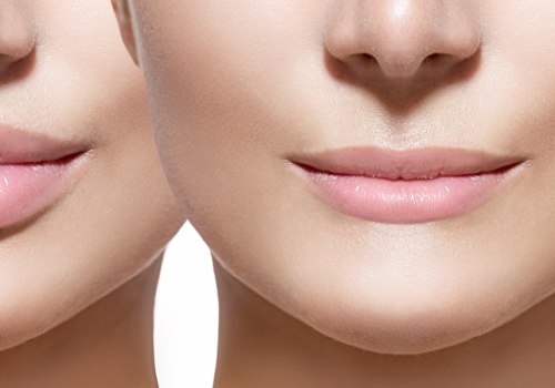 Are Lip Fillers and Botox Different?