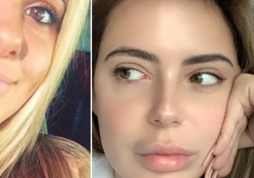 Dissolving Lip Fillers: A Comprehensive Guide