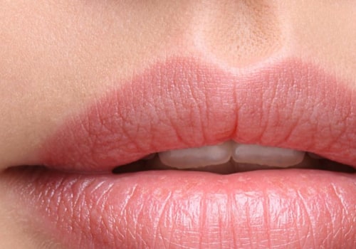 When Do Lip Fillers Settle? A Comprehensive Guide