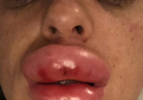 Are Lip Fillers Painful? An Expert's Perspective