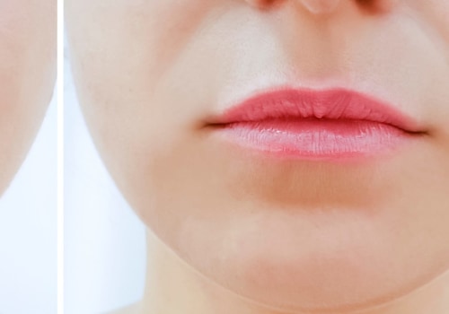 The Benefits of Lip Fillers: A Comprehensive Guide